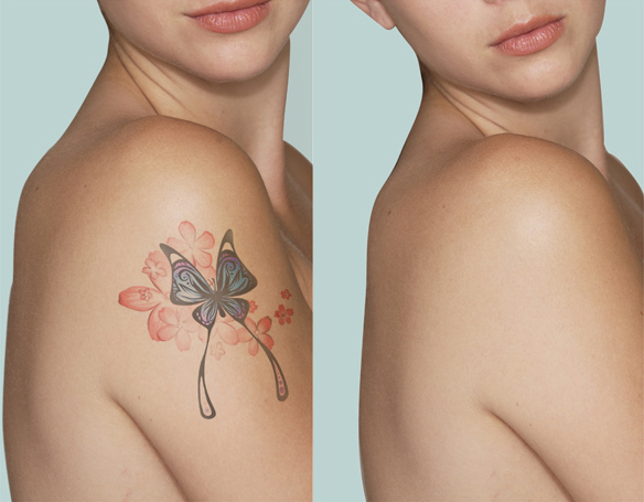 Laser-rimozione-tattoo