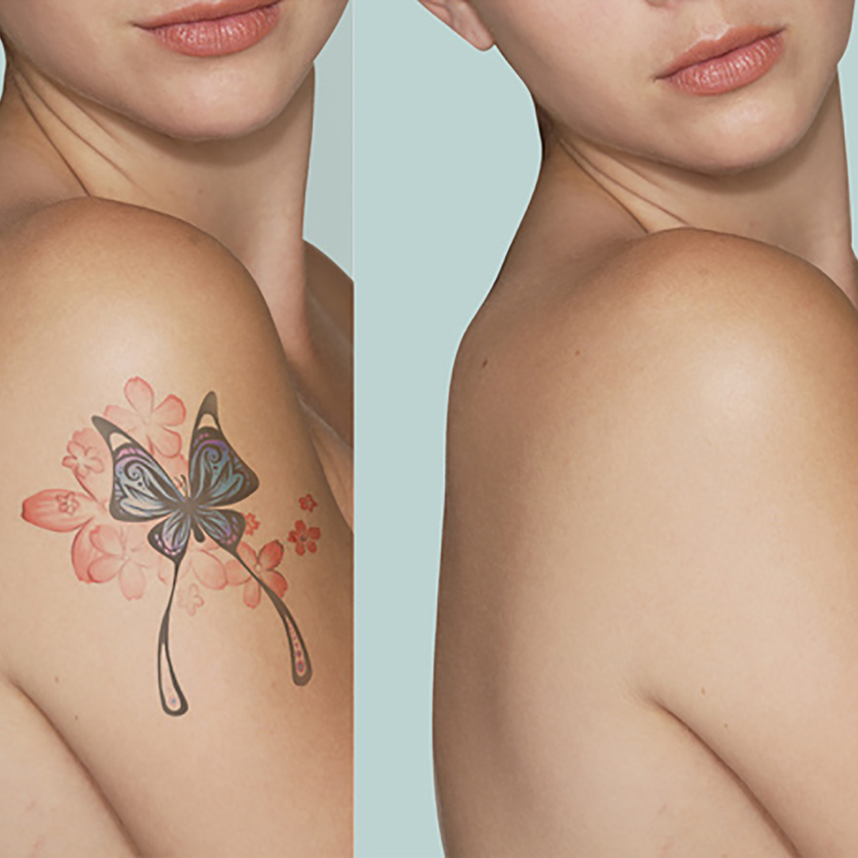 Laser-rimozione-tattoo2