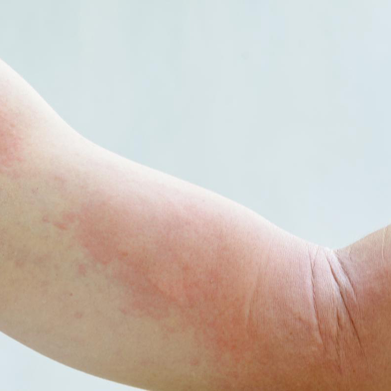 orticaria-acuta-cosa-fare